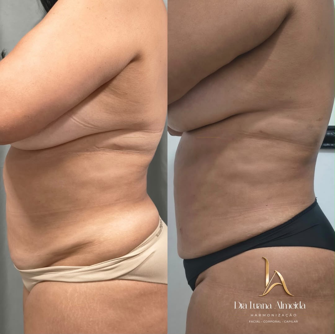 Protocolo endolaser — antes e depois