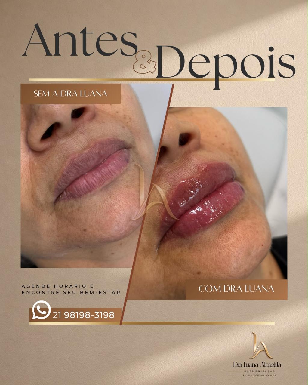 Escultura Labial — antes e depois