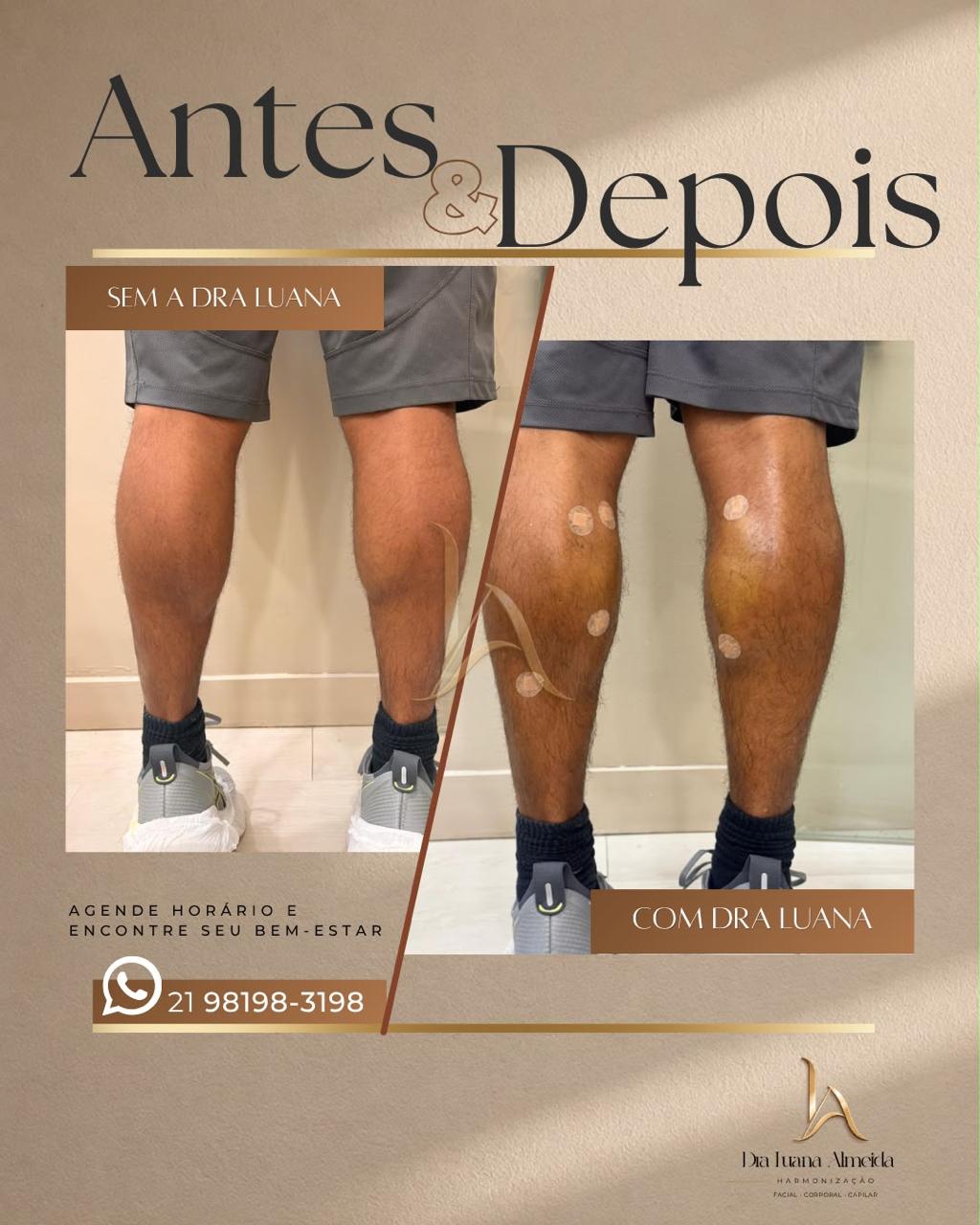 Harmonização de panturrilha — antes e depois