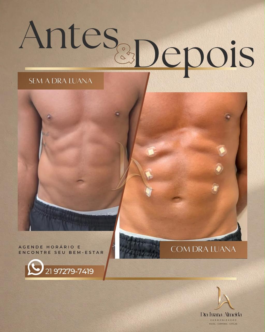 Preenchimento do abdome com ácido hialurônico — antes e depois