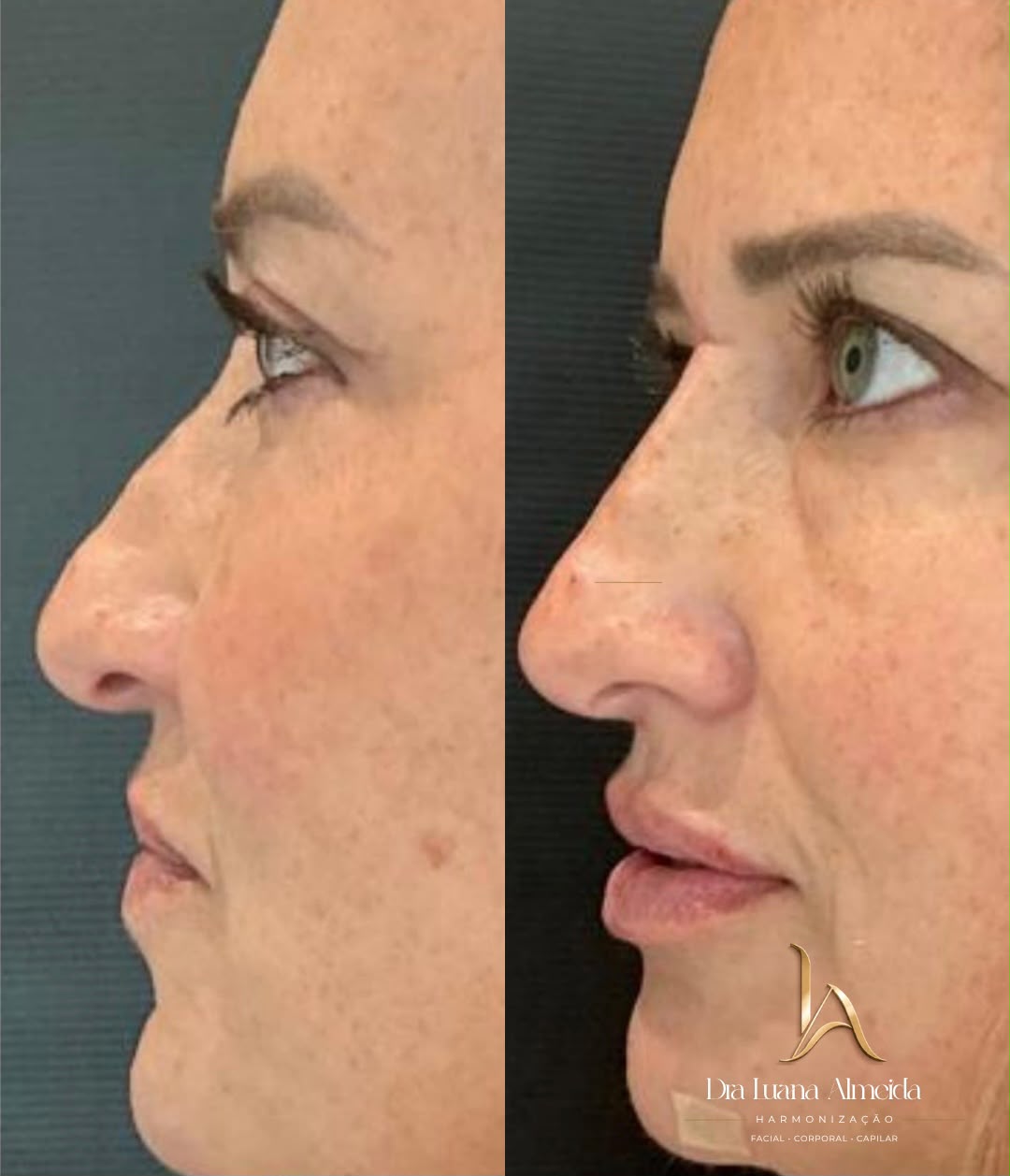 Full face — antes e depois