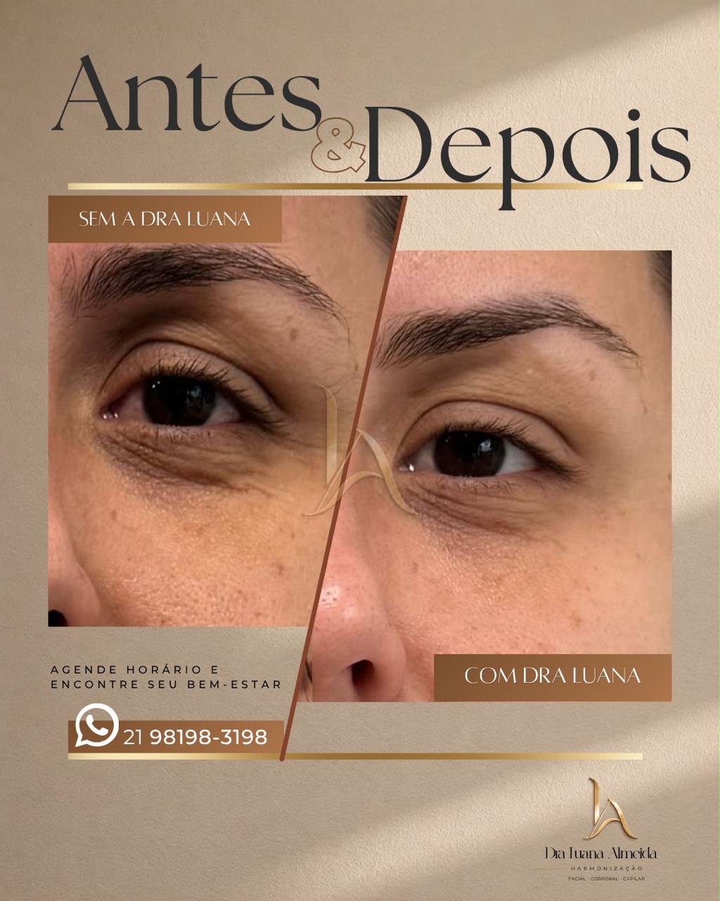 Toxina para abertura do olhar — antes e depois