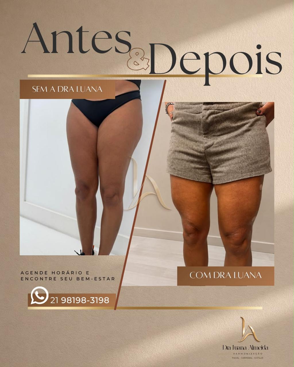 Harmonização de coxa — antes e depois