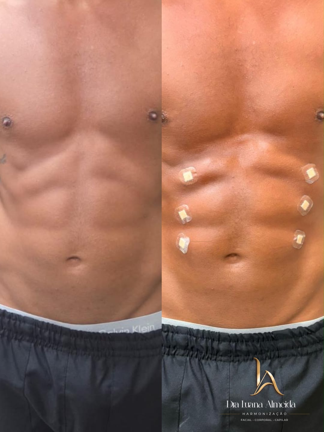 Preenchimento do abdome — antes e depois