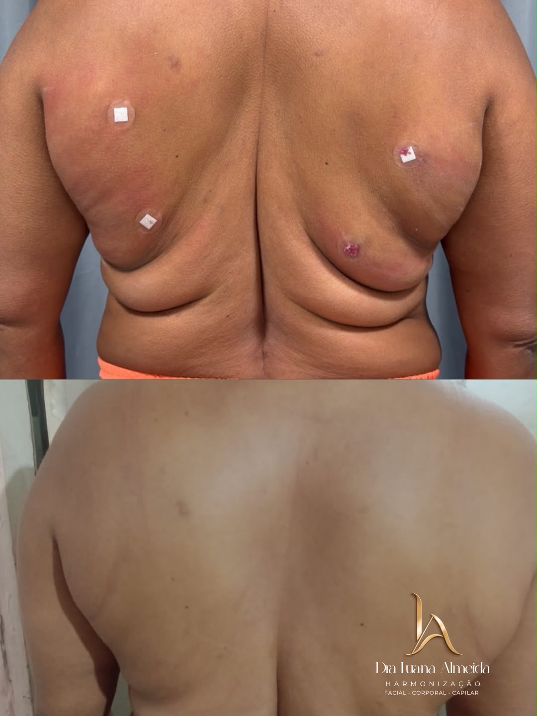 01 Sessão de Endolaser — antes e depois
