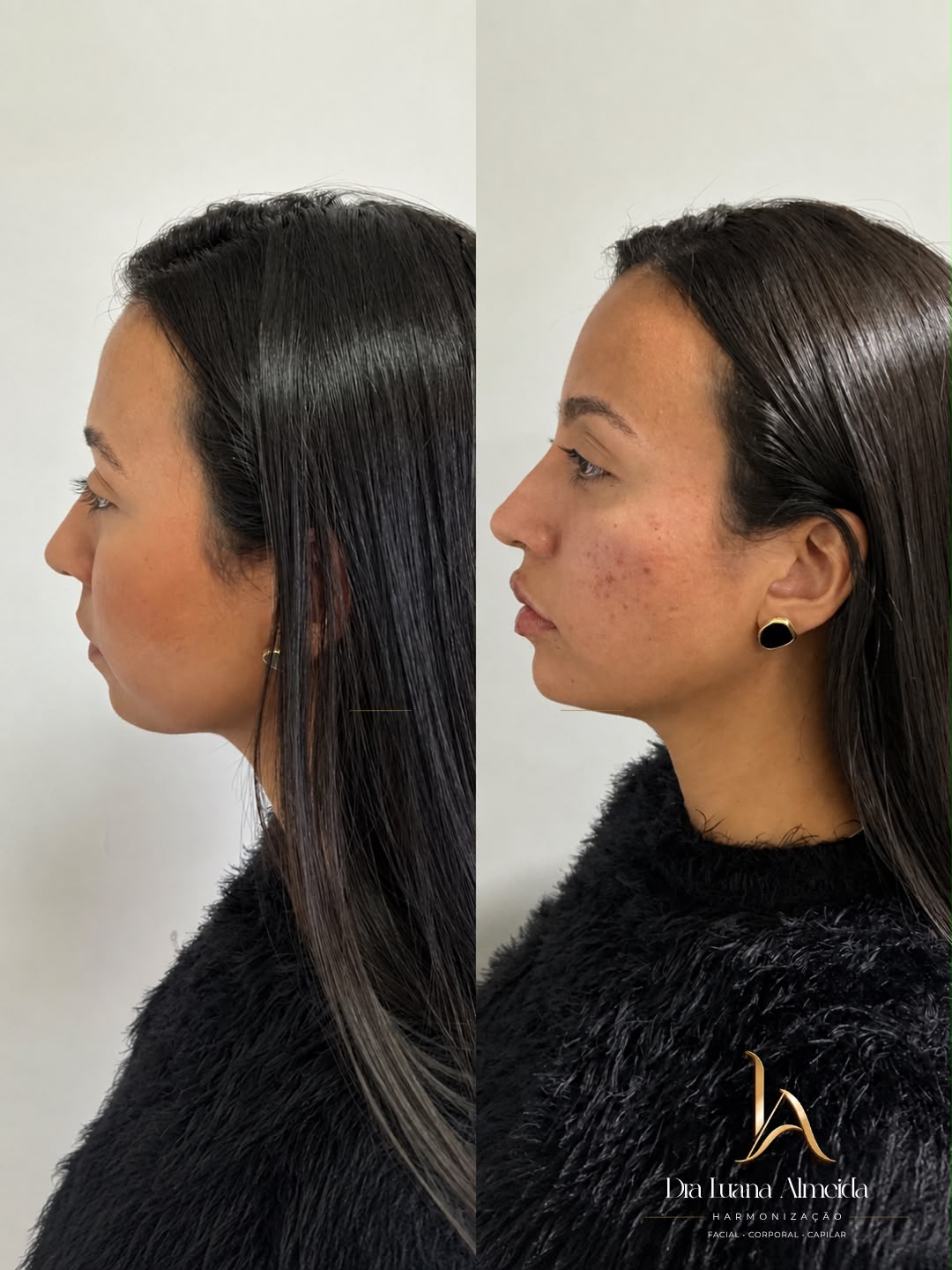 Full face — antes e depois
