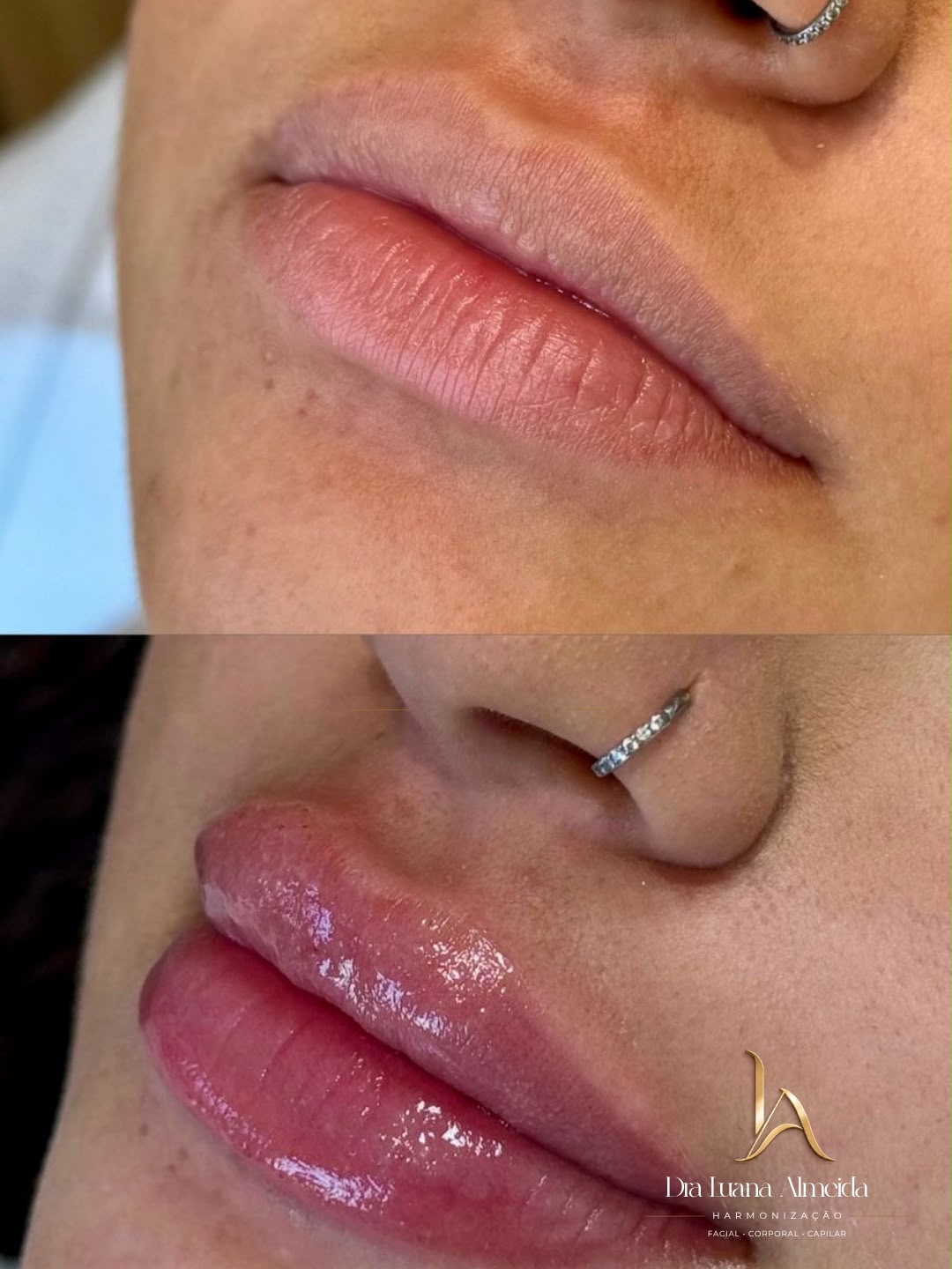 Preenchimento labial — antes e depois