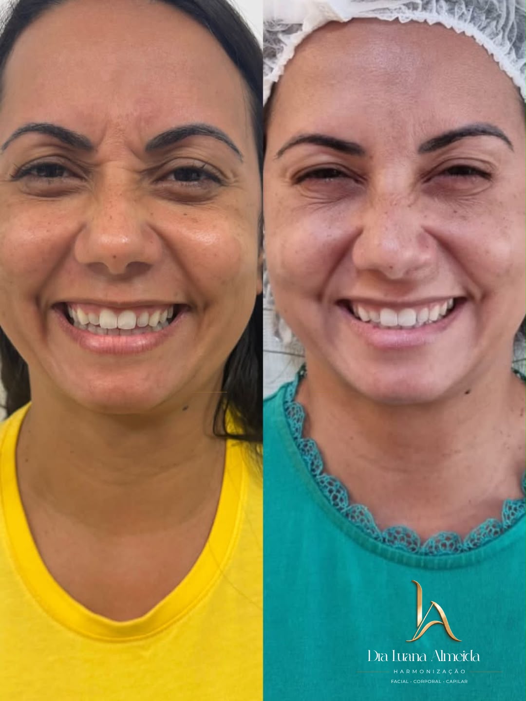 Toxina botulínica — antes e depois