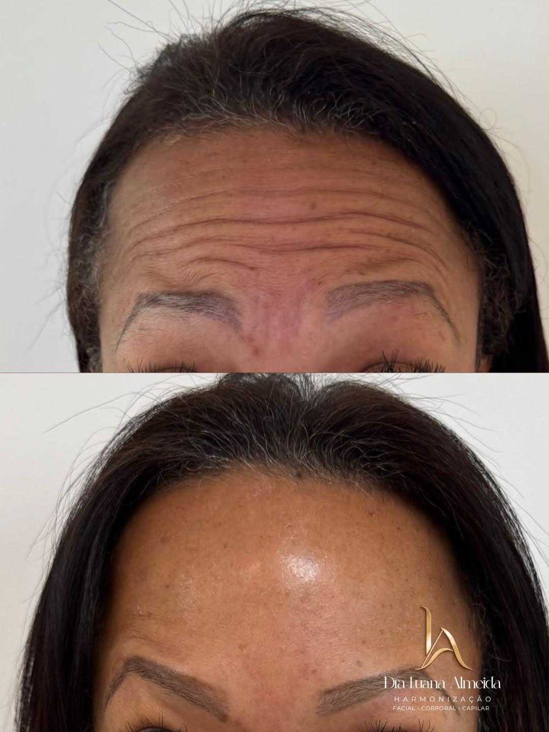 Toxina botulínica — antes e depois