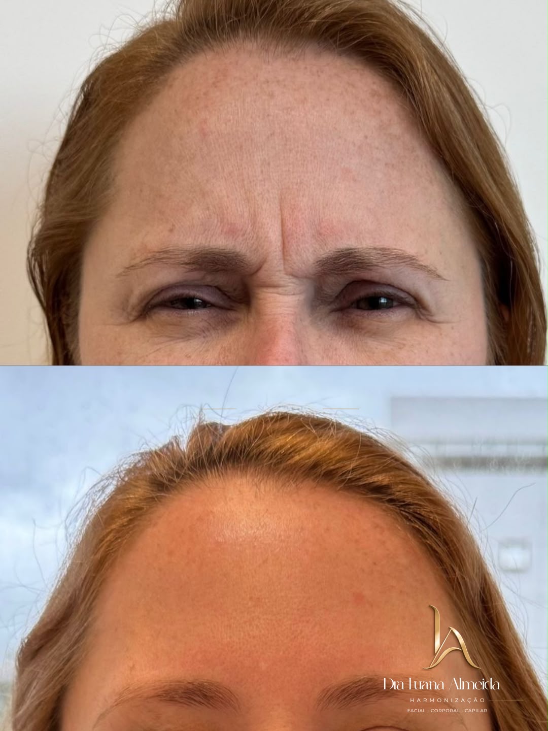 Toxina botulínica — antes e depois