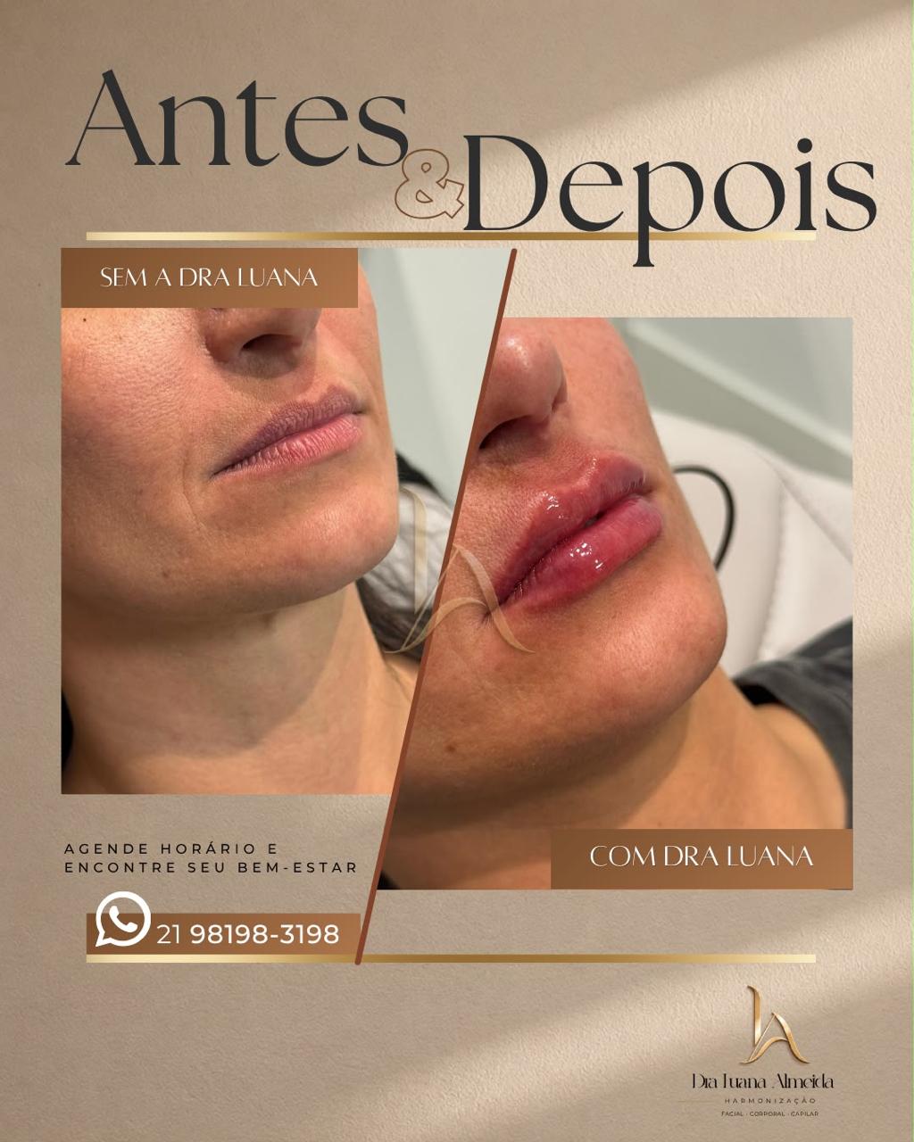Escultura Labial — antes e depois