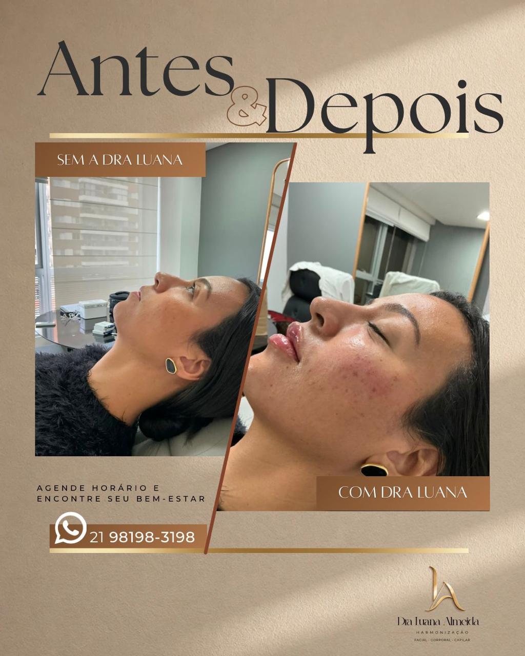 Full face — antes e depois